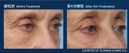 眼部：療程前與第 4 次療程後對比（個案二）