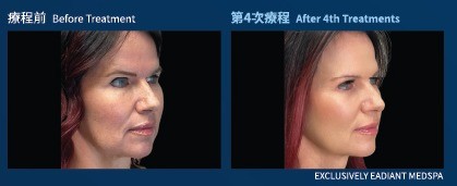 面部輪廓：療程前與第 4 次療程後對比（個案一）