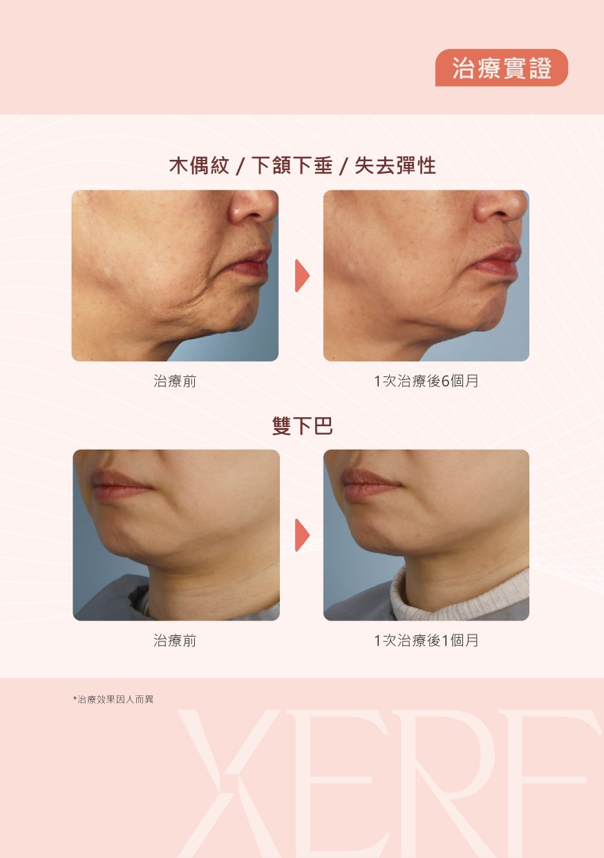 XERF 治療實證：木偶紋／下頷下垂（1次治療後6個月）；雙下巴（1次治療後1個月）
