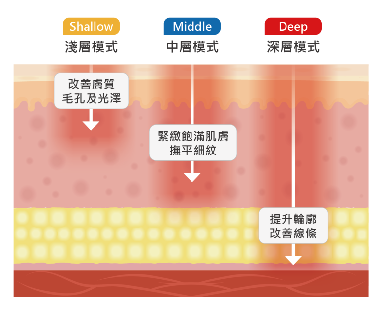 XERF 雙頻電波治療深度示意圖：真皮層至筋膜層