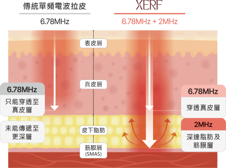 XERF 蜘蛛網面設計面部治療頭